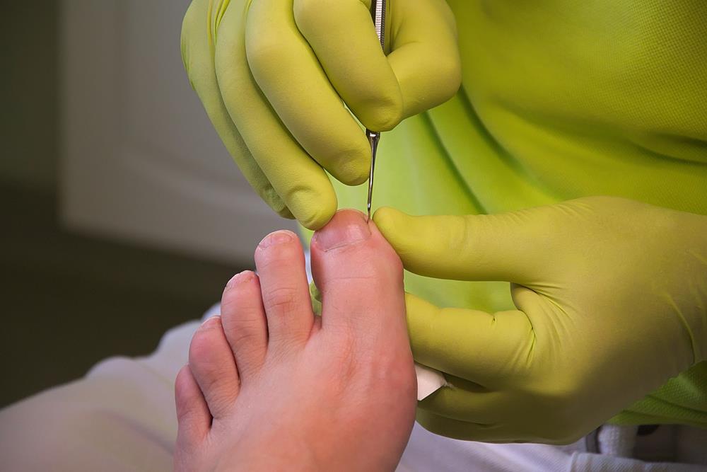 Ingrown Toenails  Houston, TX 