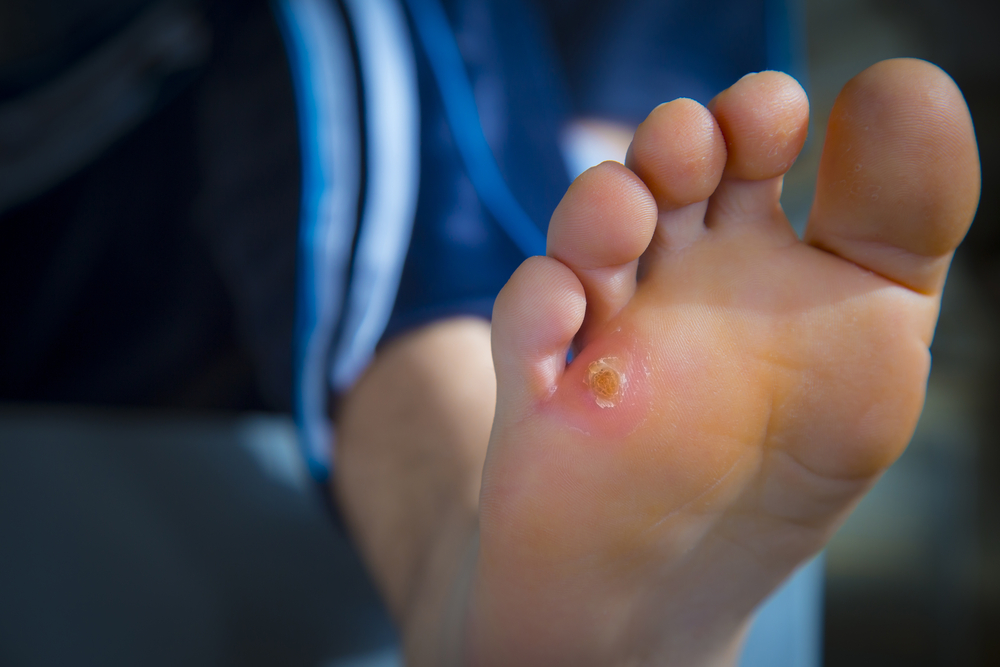Wound Care  Houston, TX 